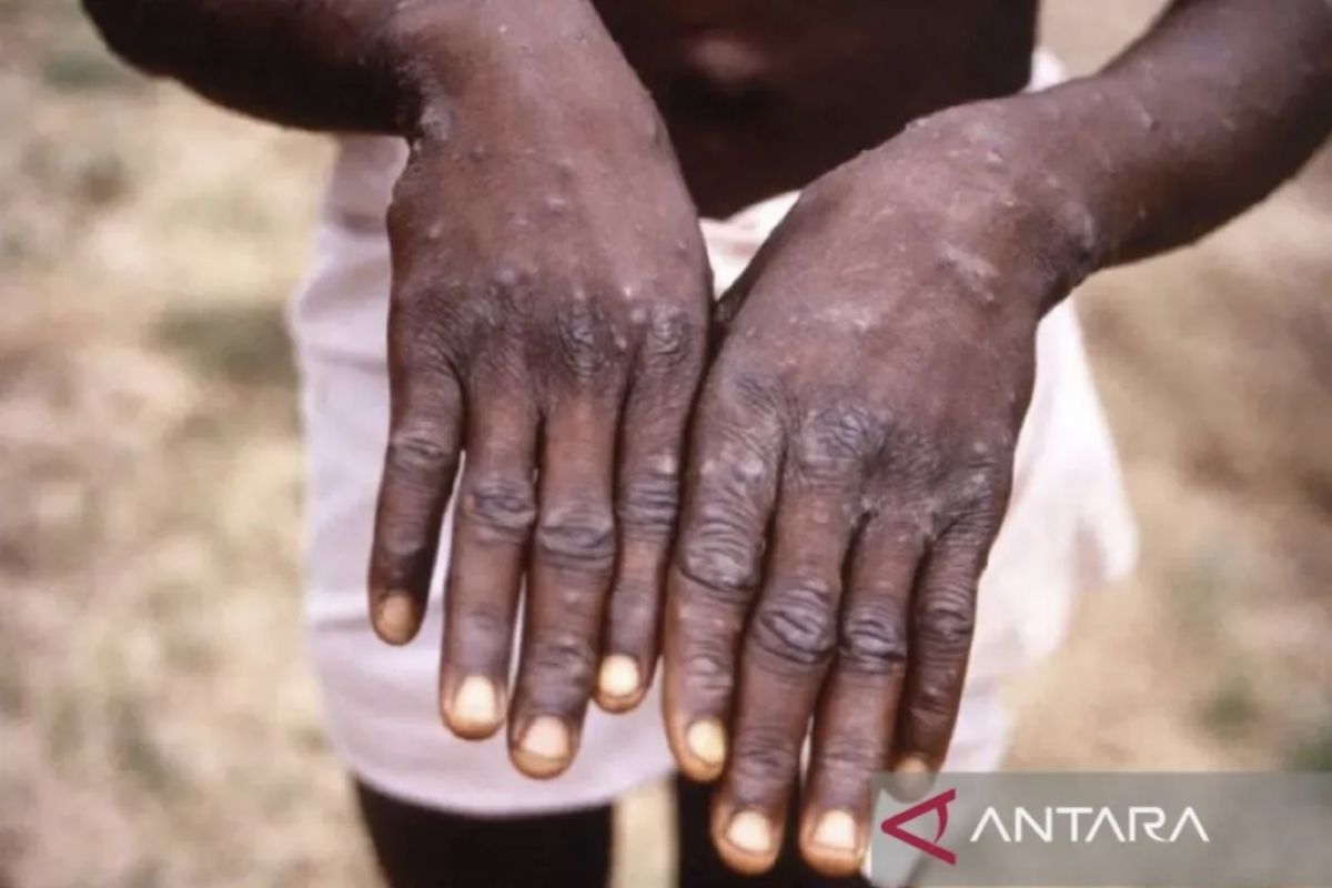 Govt prioritizing monkeypox vaccines for vulnerable groups: official