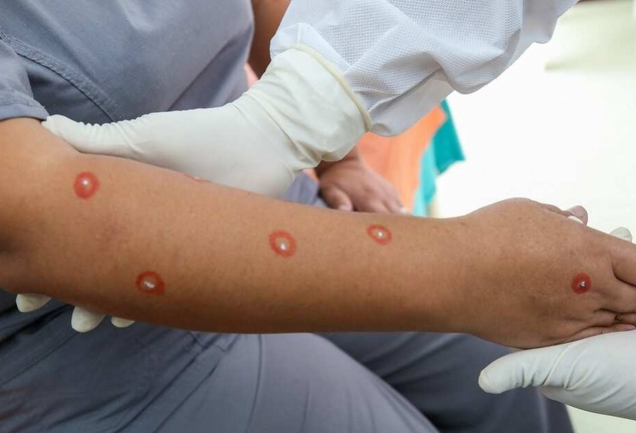 Two men returning from China diagnosed with monkeypox in St. Petersburg