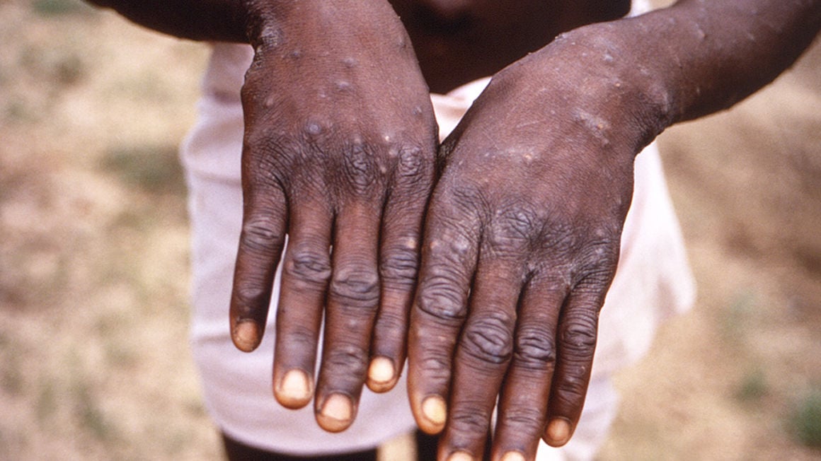 Concerns grow as Mpox cases soar in DR Congo